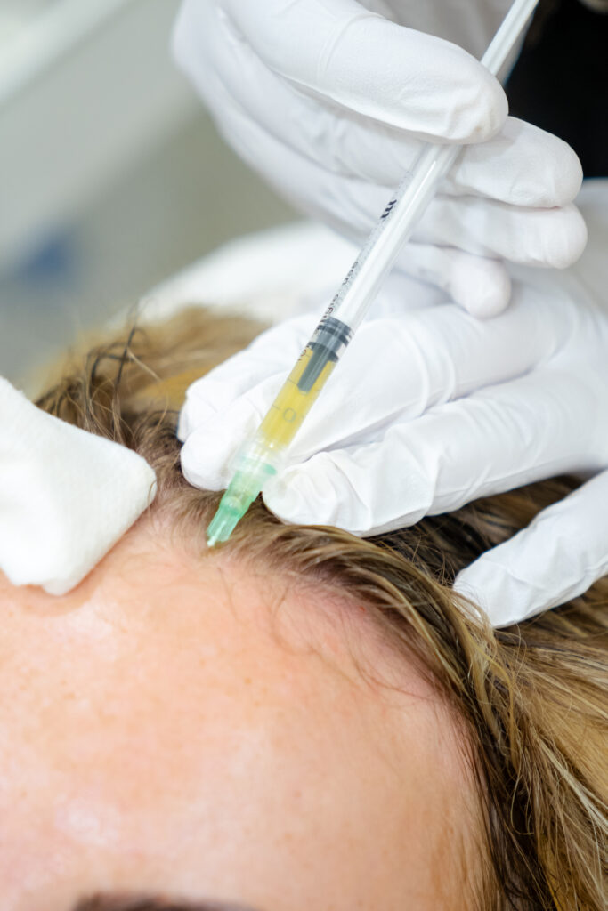Exosomes Hair Salus Clinic