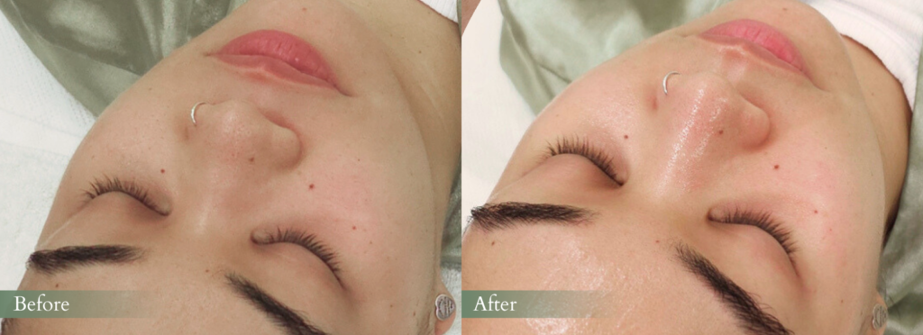 Hydrafacial Results - Before & After
