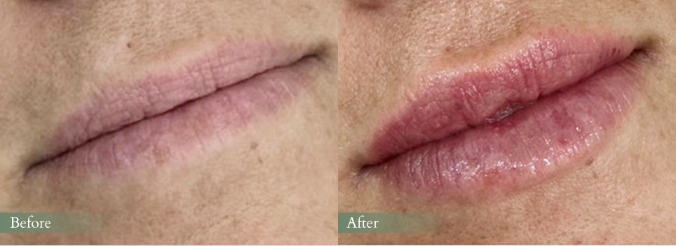 Lip Filler